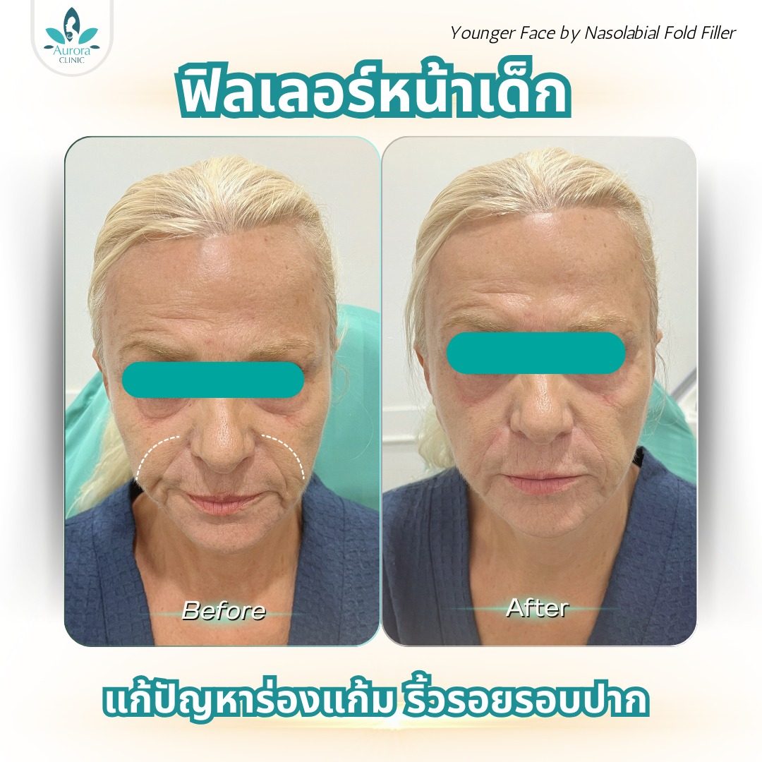 ฟิลเลอร์...เวทมนตร์ที่ช่วยย้อนวัยได้อย่างไร?