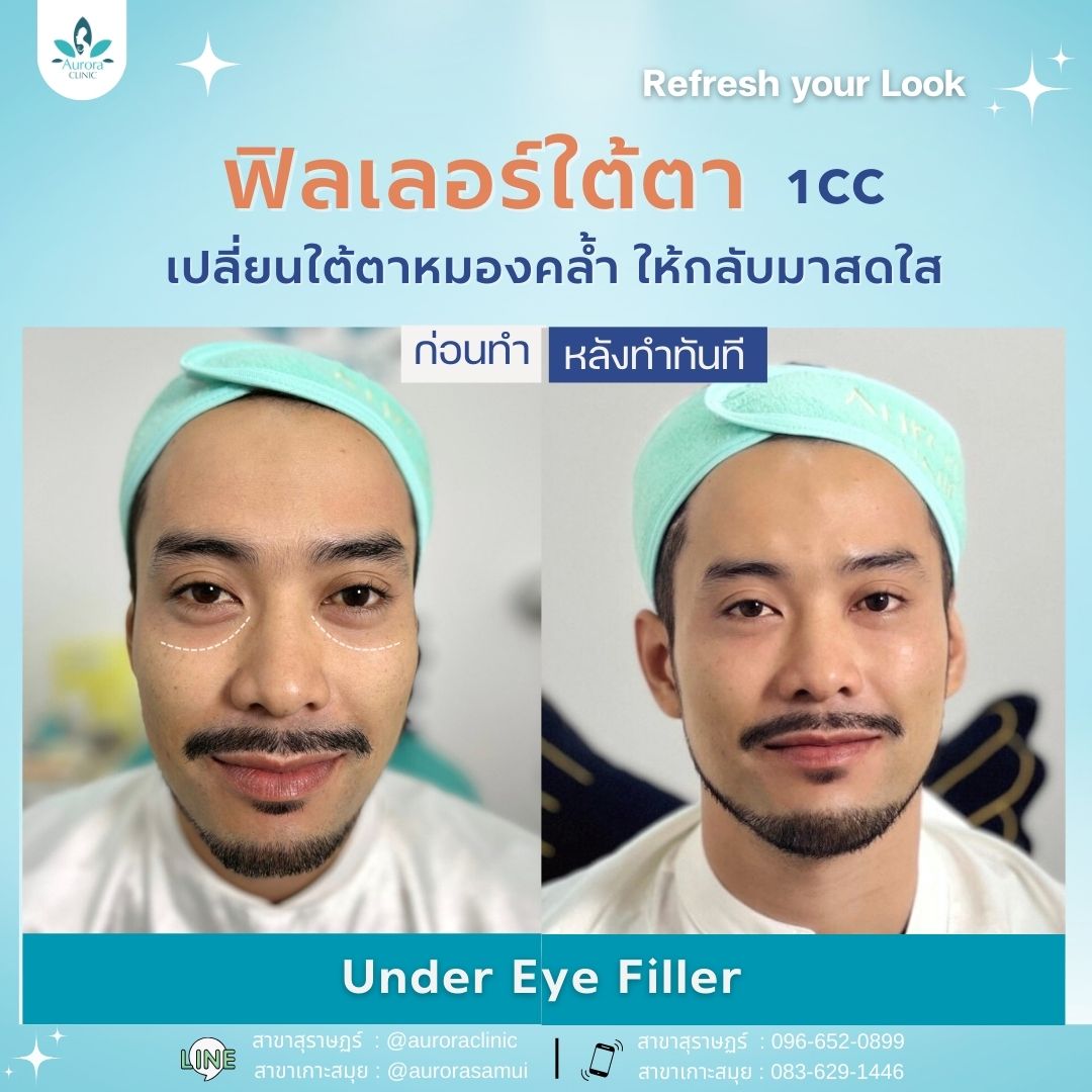 ฟิลเลอร์ใต้ตา (Under Eyes/Tear Troughs)