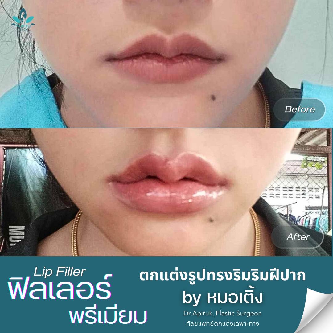 ฟิลเลอร์ริมฝีปาก (Lips)